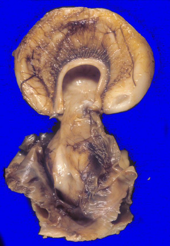 7 Holoprosencephaly (Case 7)A