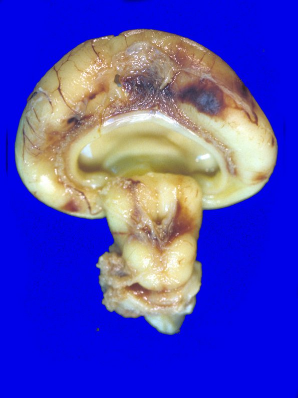 8 Holoprosencephaly (Case 8) 1AA