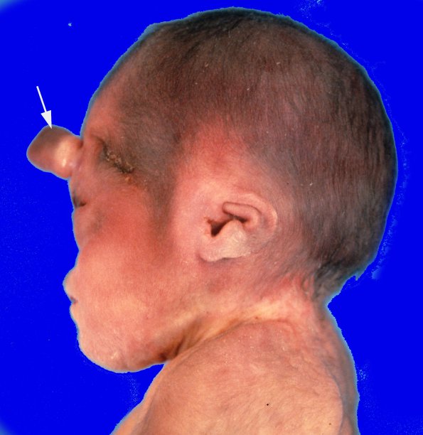 9A2 Holoprosencephaly (Case 9) 3A