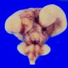 9B Holoprosencephaly (Case 9) 1A