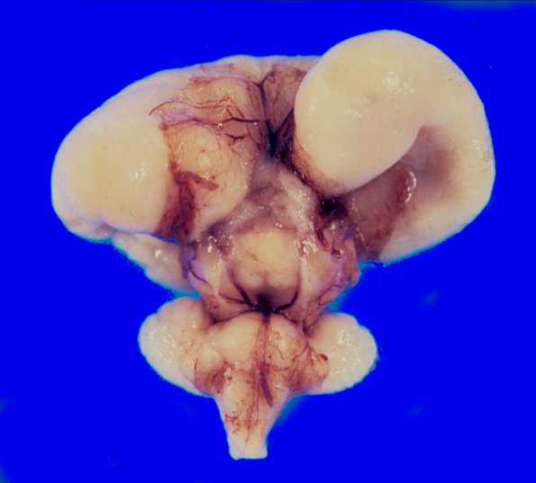 9B Holoprosencephaly (Case 9) 1A