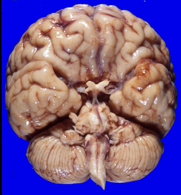 1A1 Holoprosencephaly, 1 ACA & Olfactory Aplasia 1 (Case 1)AA