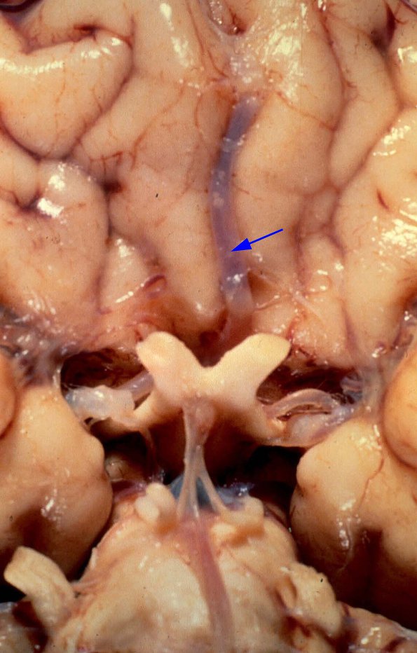 1A2 Holoprosencephaly, 1 ACA & Olfactory Aplasia (Case 1)A