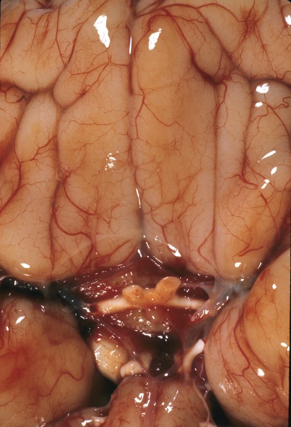 2 Holoprosencephaly (Case 2) 3