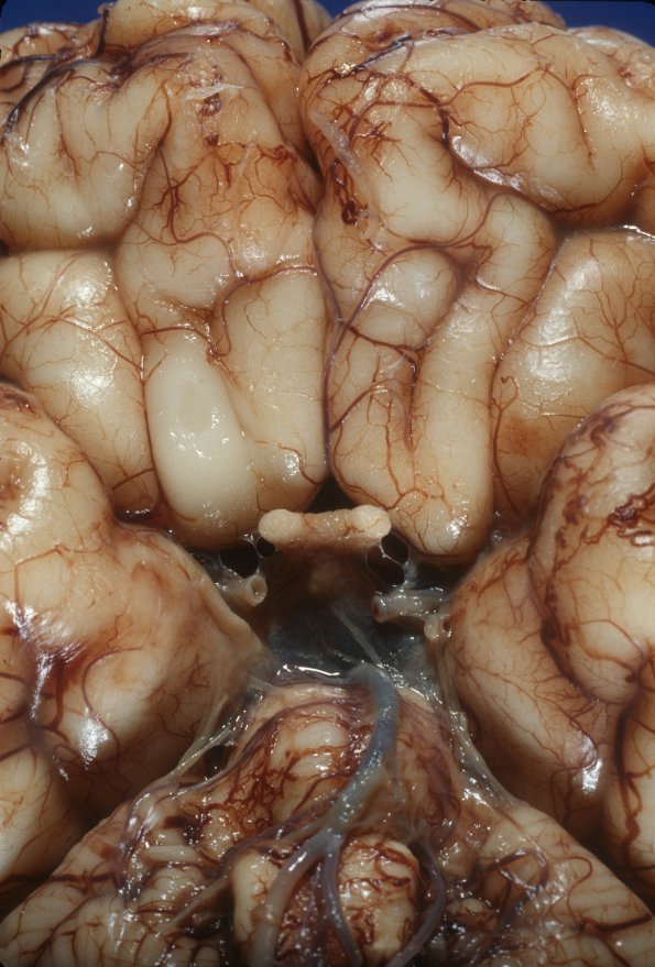 3 Holoprosencephaly, olfactory aplasia (Case 3) 1