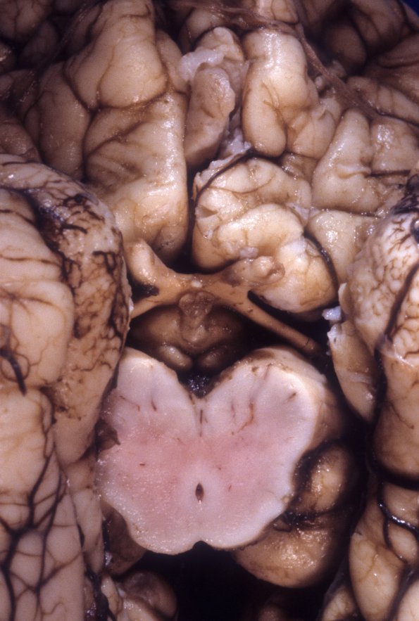 5 Olfactory Aplasia (Case 5)