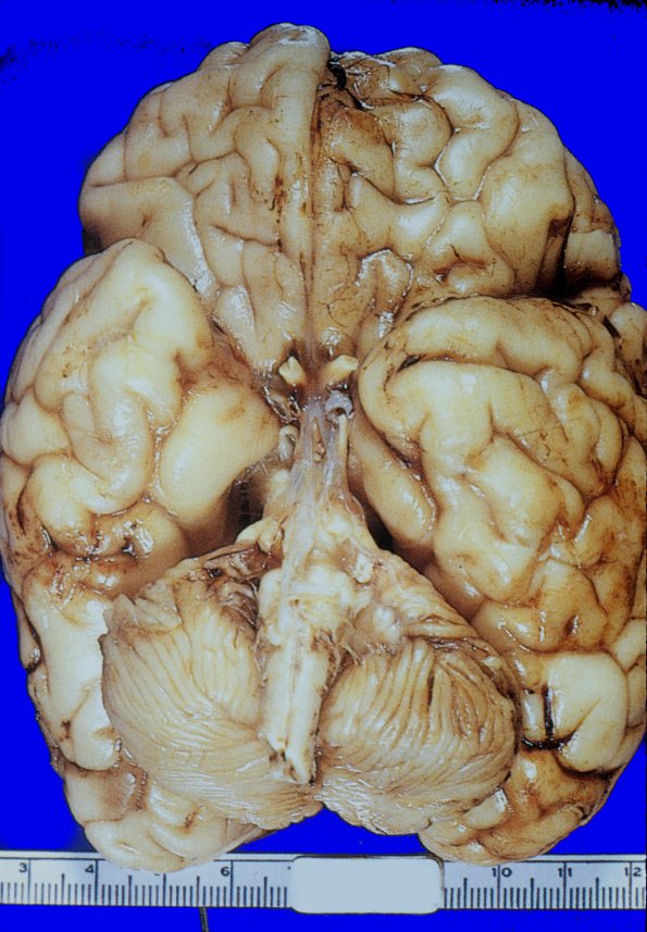 6 Holoprosencephaly & olfactory aplasia (Case 6) 1A