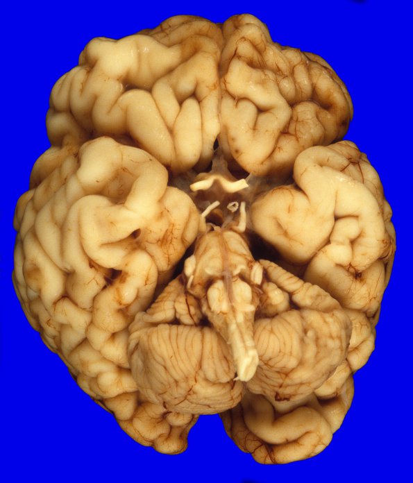 6 Malformation, CHARGE syndrome, olfactory aplasia (Case 7) 2A