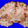 10A1 Holoprosencephaly (Case 10) 1A