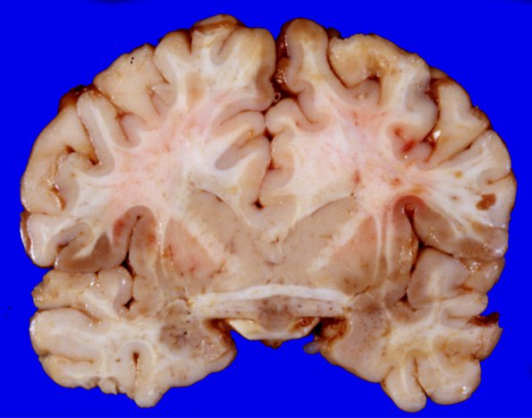 10A1 Holoprosencephaly (Case 10) 1A