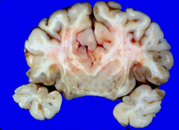 10A2 Holoprosencephaly (Case 10) 2A