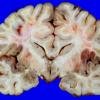 10A3 Holoprosencephaly (Case 10) 3Aa