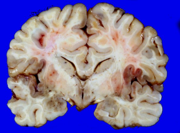 10A3 Holoprosencephaly (Case 10) 3Aa