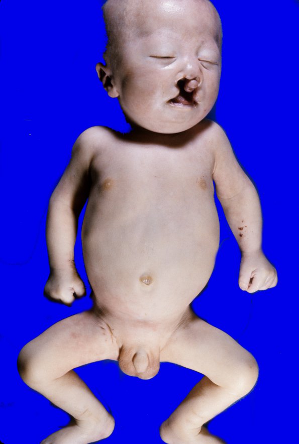 11A Holoprosencephaly (Case 11) 1A