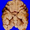 11B1 Holoprosencephaly (Case 11) 0AA