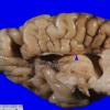 11B2 Holoprosencephaly (Case 11) 2A