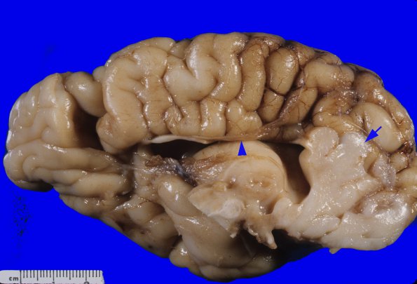 11B2 Holoprosencephaly (Case 11) 2A