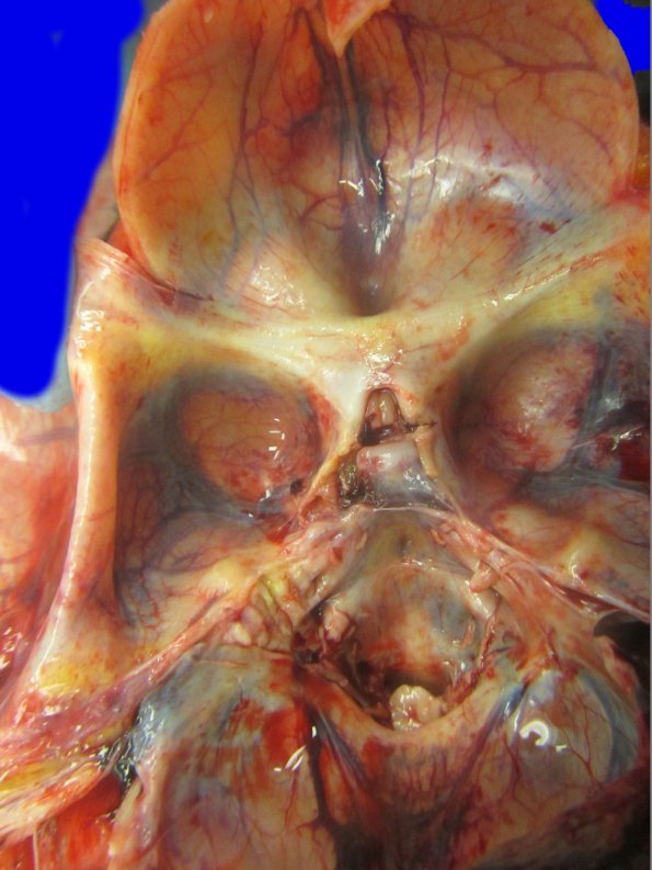 12A2 Holoprosencephaly (Case 12) _1A