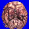 12B1 Holoprosencephaly (Case 12) _7A