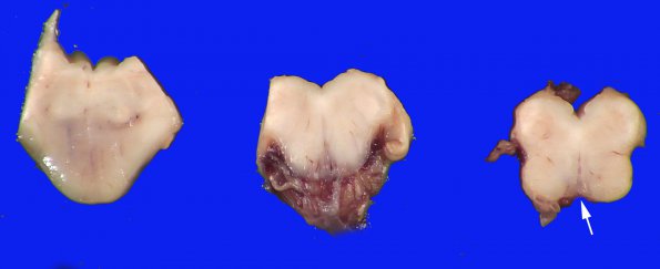 12B10 Holoprosencephaly (Case 12) _22 copy