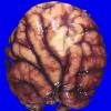 12B3 Holoprosencephaly (Case 12) _8A