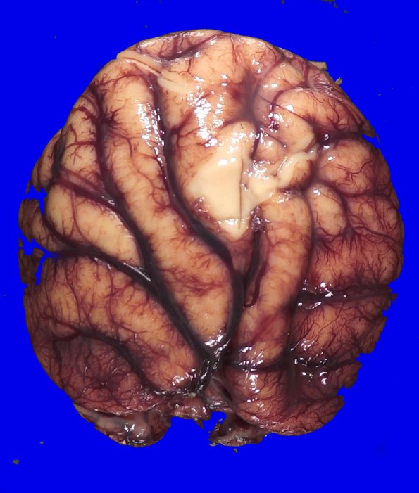 12B3 Holoprosencephaly (Case 12) _8A