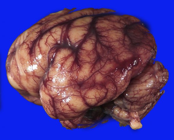 12B4 Holoprosencephaly (Case 12) _9