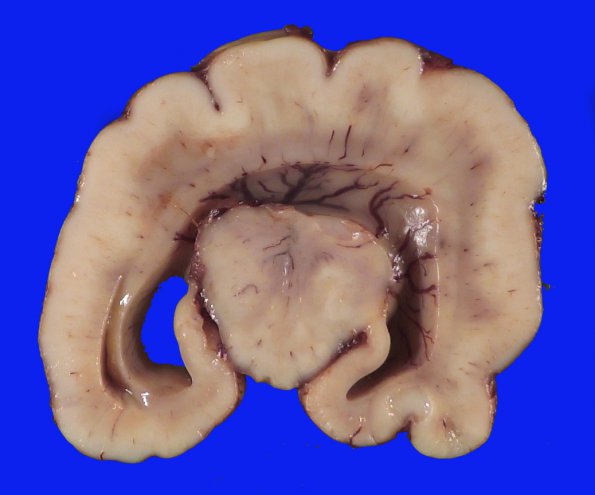 12B6 Holoprosencephaly (Case 12) _14