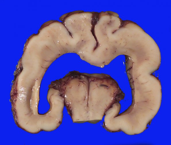 12B7 Holoprosencephaly (Case 12) _15