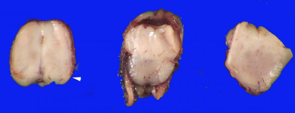 12B9 Holoprosencephaly (Case 12) _21 copy