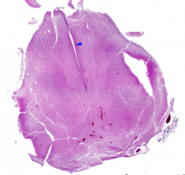 12C1 Holoprosencephaly (Case 12) N2 H&E WM copy