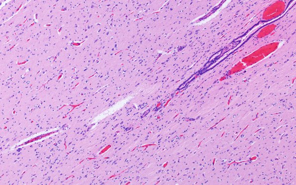 12C2 Holoprosencephaly (Case 12) N2 H&E 1