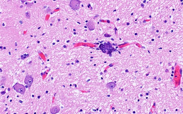 12C3 Holoprosencephaly (Case 12) N2 H&E 3