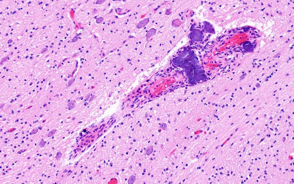 12C4 Holoprosencephaly (Case 12) N2 H&E 2