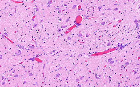 12C5 Holoprosencephaly (Case 12) N2 H&E 4