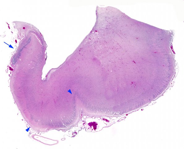 12D1 Holoprosencephaly (Case 12) N3 H&E WM copy