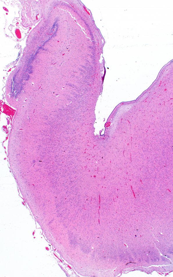 12D2 Holoprosencephaly (Case 12) N3 H&E 8