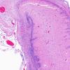 12D3 Holoprosencephaly (Case 12) N3 H&E 1