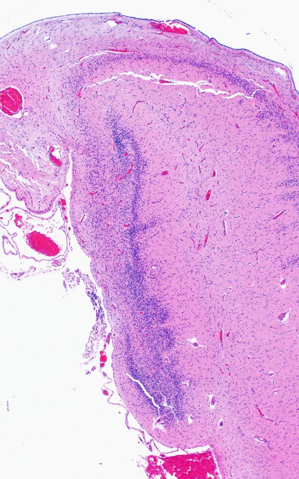 12D3 Holoprosencephaly (Case 12) N3 H&E 1