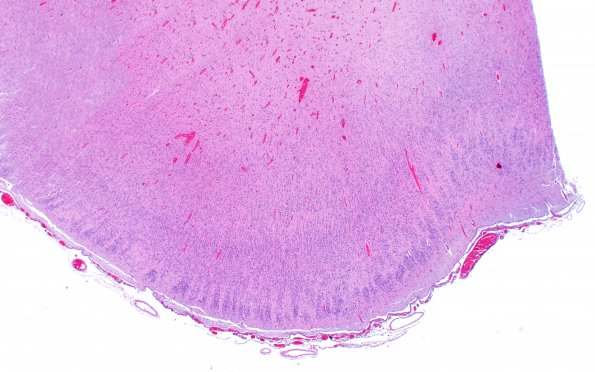 12D4 Holoprosencephaly (Case 12) N3 H&E 5