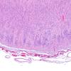 12D5 Holoprosencephaly (Case 12) N3 H&E 4