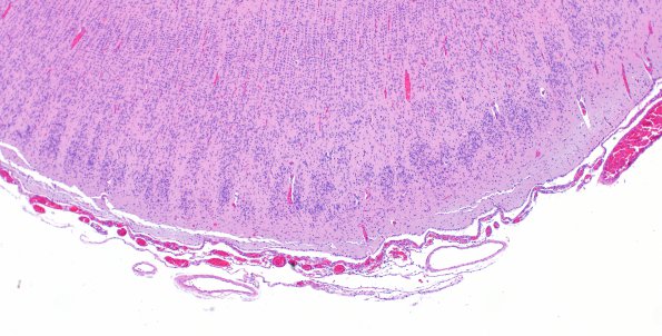 12D5 Holoprosencephaly (Case 12) N3 H&E 4