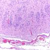 12D6 Holoprosencephaly (Case 12) N3 H&E 3