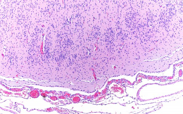 12D6 Holoprosencephaly (Case 12) N3 H&E 3