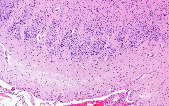 12D7 Holoprosencephaly (Case 12) N3 H&E 6