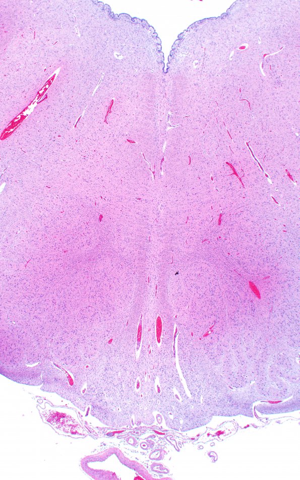 12E2 Holoprosencephaly (Case 12) N2 H&E 2