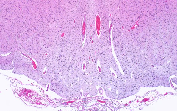 12E3 Holoprosencephaly (Case 12) N8 H&E 1