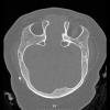 13A1 (Case 13) Bone axial thin 2 - Copy