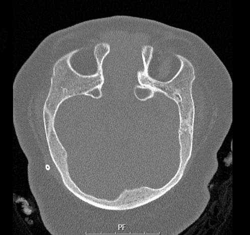 13A1 (Case 13) Bone axial thin 2 - Copy