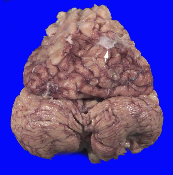 13B1 (Case 13).Ab